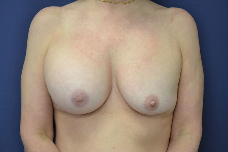 Revisión de Implantes mamarios