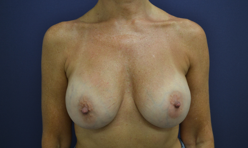 Revisión de Implantes mamarios